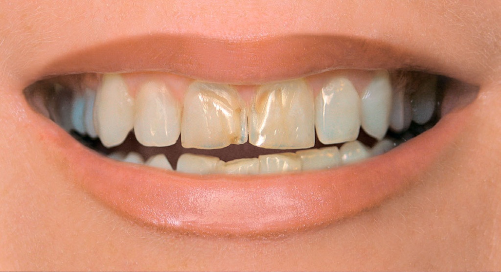 Зубы с пятнами и сколами